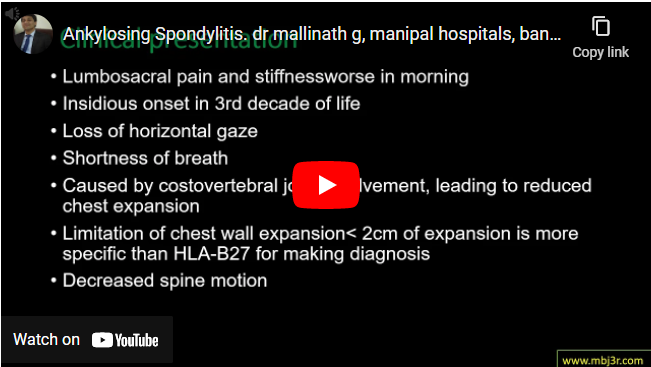 Ankylosing Spondylitis