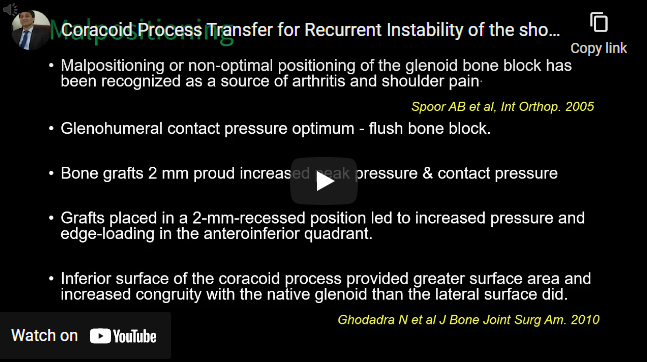 Coracoid Process Transfer for Recurrent Instability of the Shoulder