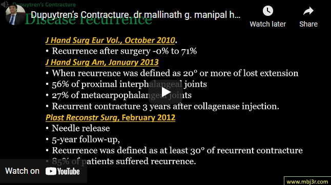 Dupuytren’s Contracture