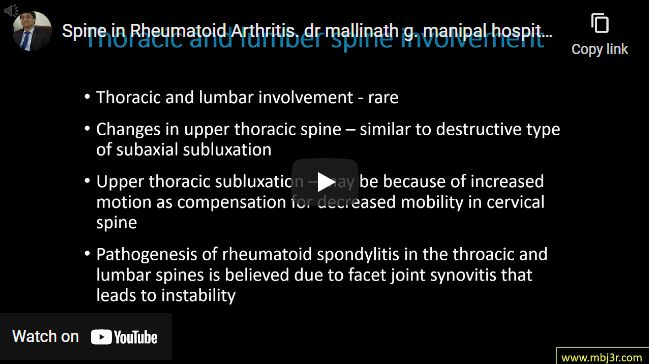 Spine in Rheumatoid Arthritis