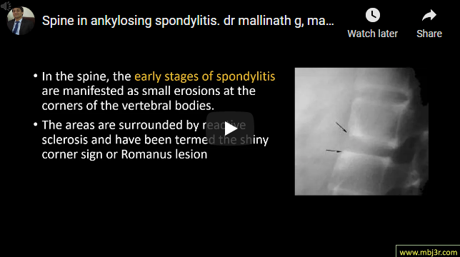 Spine in ankylosing spondylitis