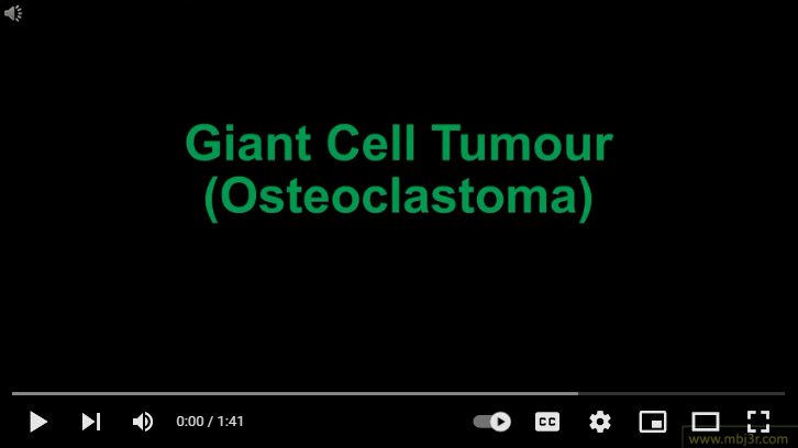 Giant Cell Tumor Osteoclastoma